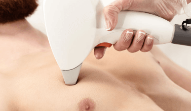 Gynecomastia